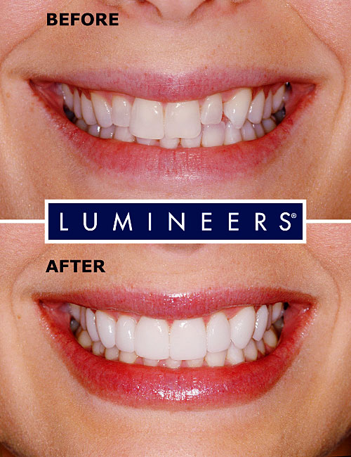 Licówki Lumineers: uśmiech przed i po