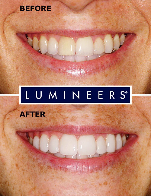Licówki Lumineers: uśmiech przed i po