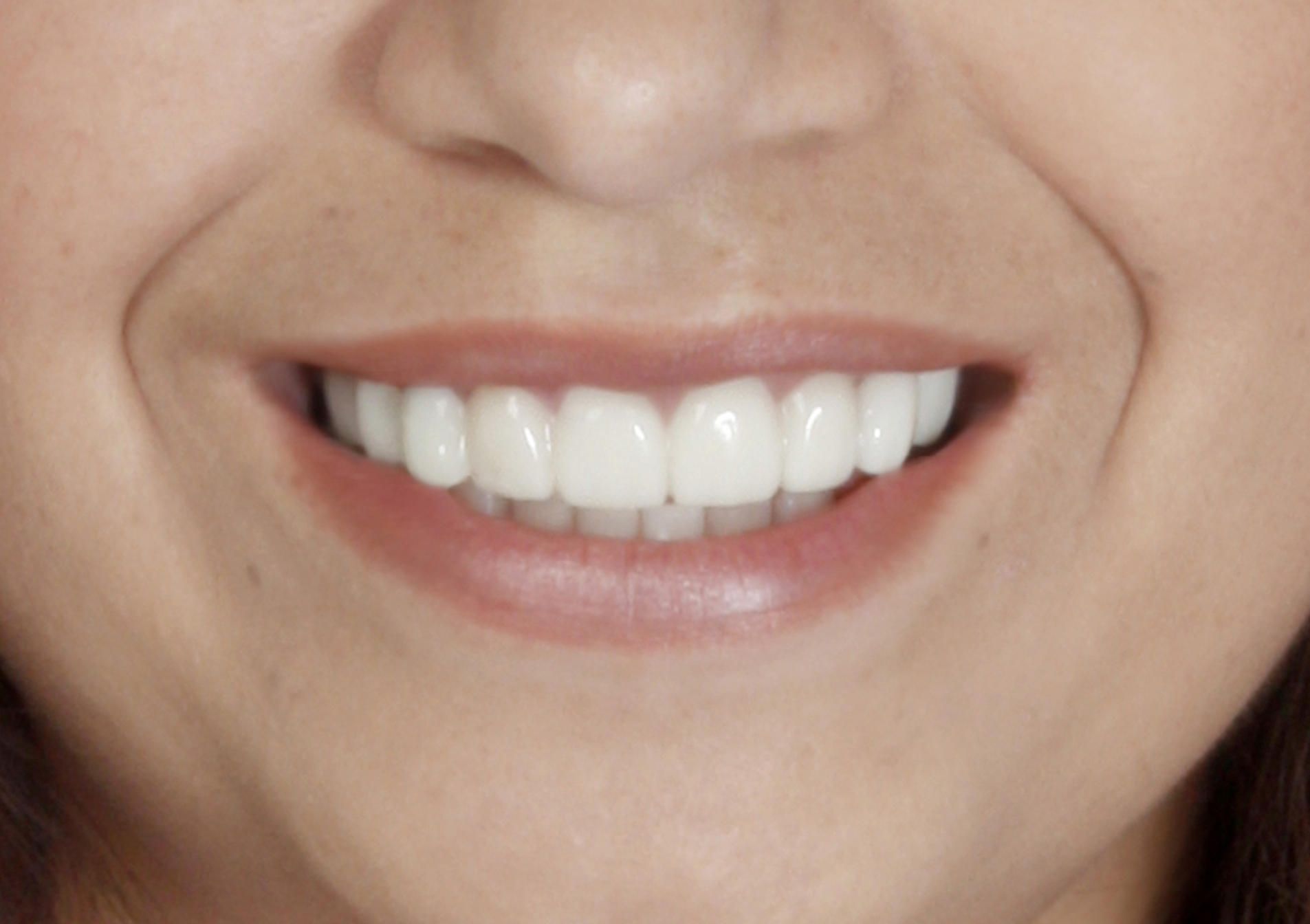 Snap-On Smile: uśmiech po
