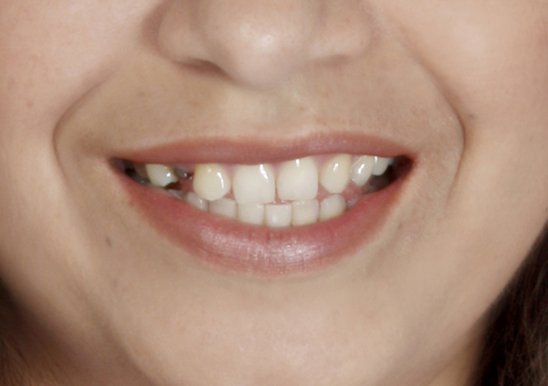 Snap-On Smile: uśmiech przed